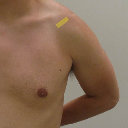 : Sonde en vue longitudinale (Position de Crass, vue de face)